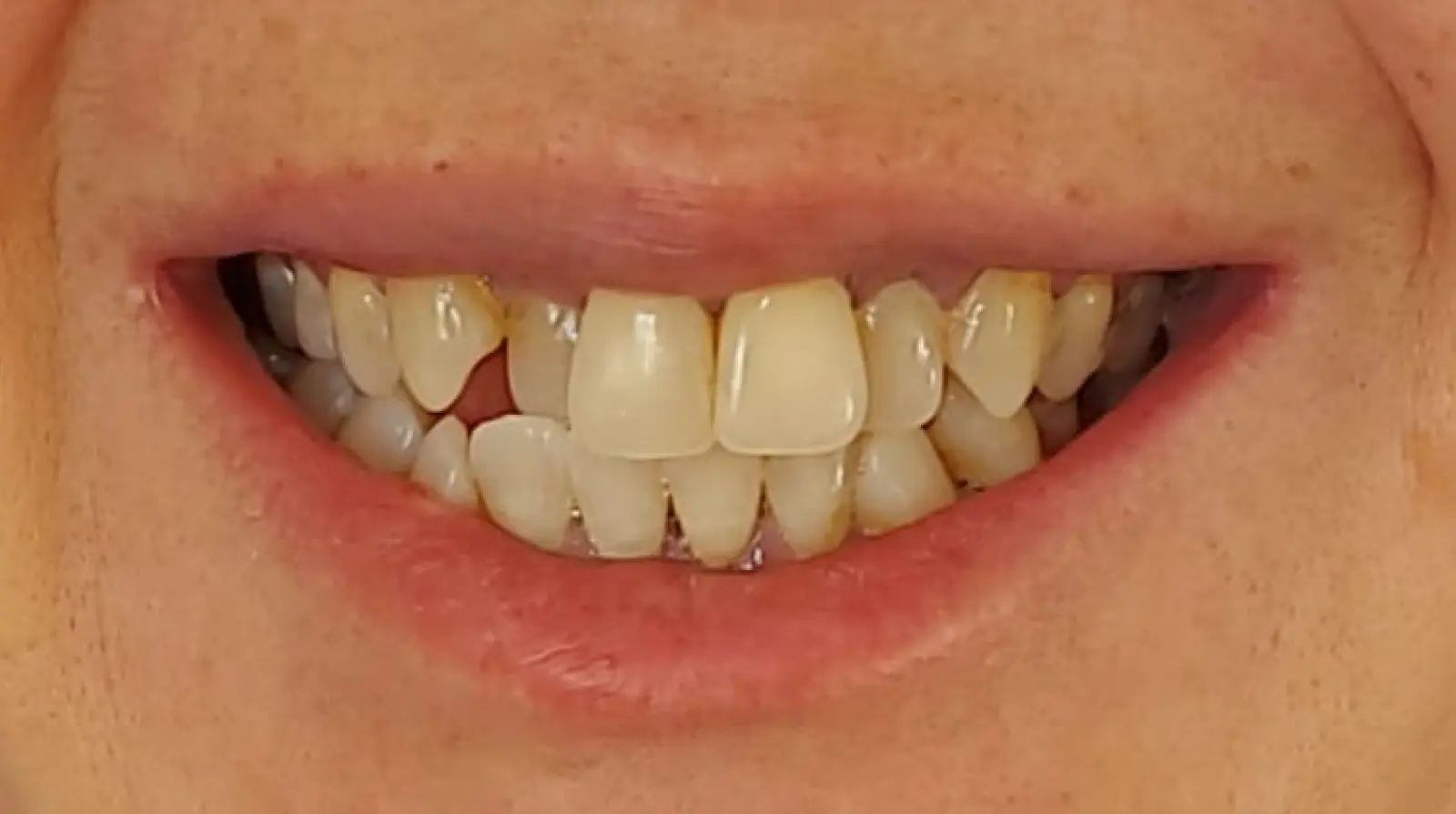 antes3
